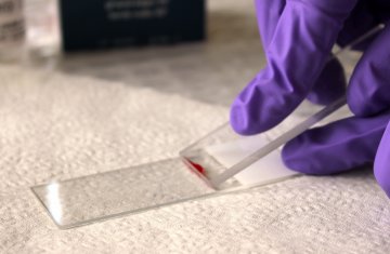 Техника приготовления мазка для исследования цитологии крови