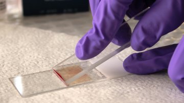 Техника приготовления мазка для исследования цитологии крови